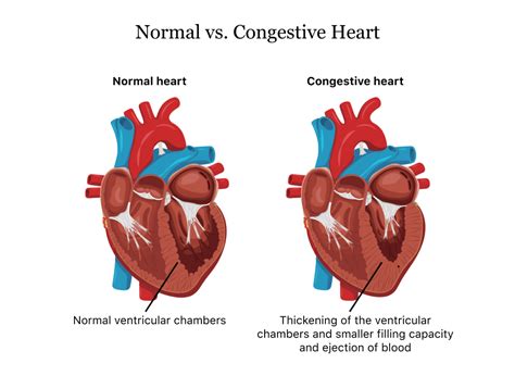 CHF: Medical Abbreviation for Congestive Heart Failure.